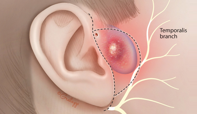Radiation Therapy Blog